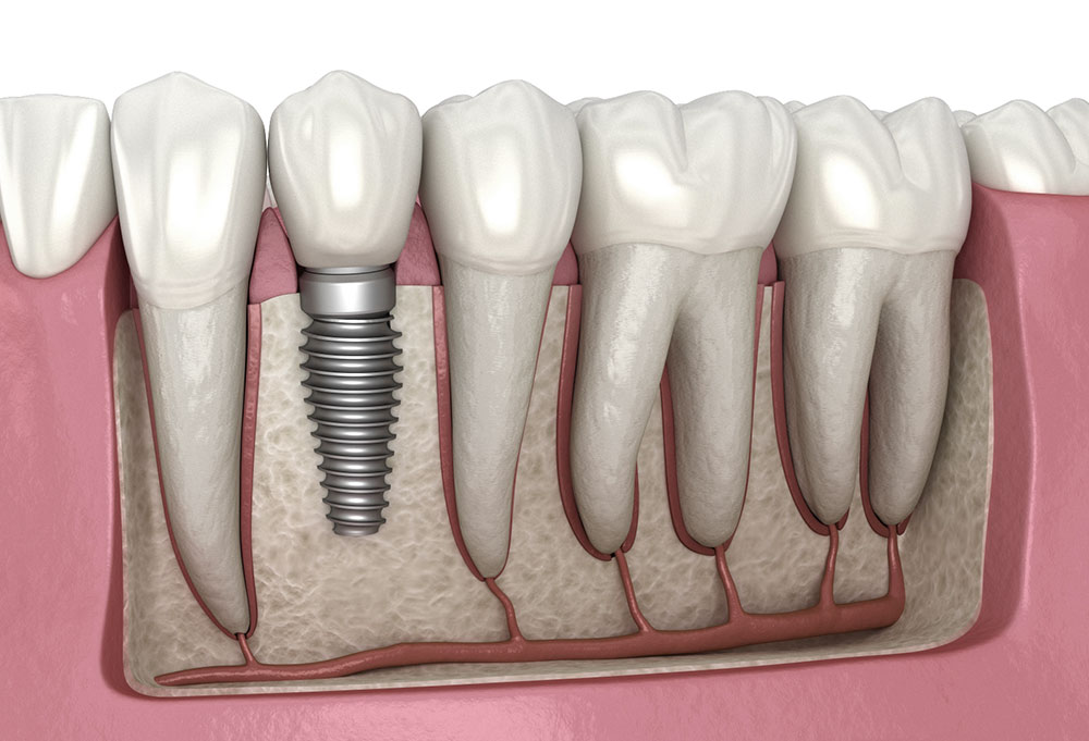 Dental implant illustration used for implant treatment section