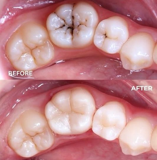 Before and after posterior tooth treatment collage