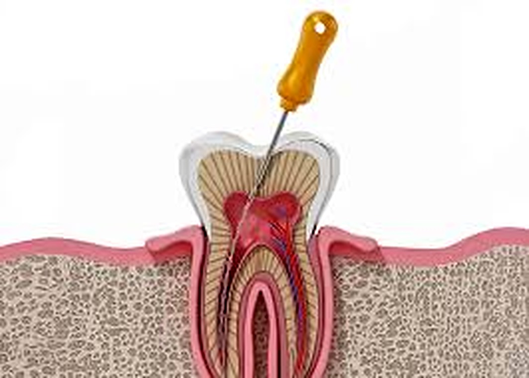 Root canal treatment visual for endodontic care